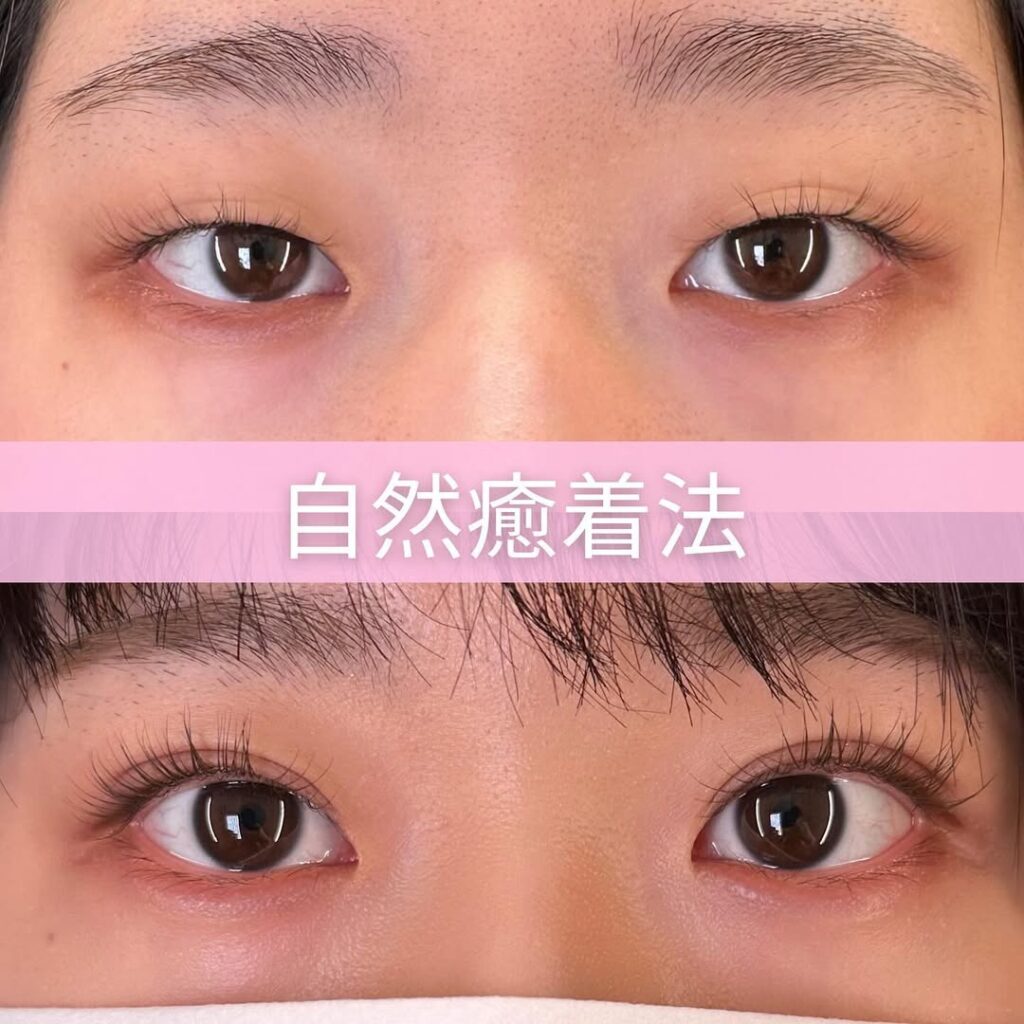 自然癒着法の症例写真