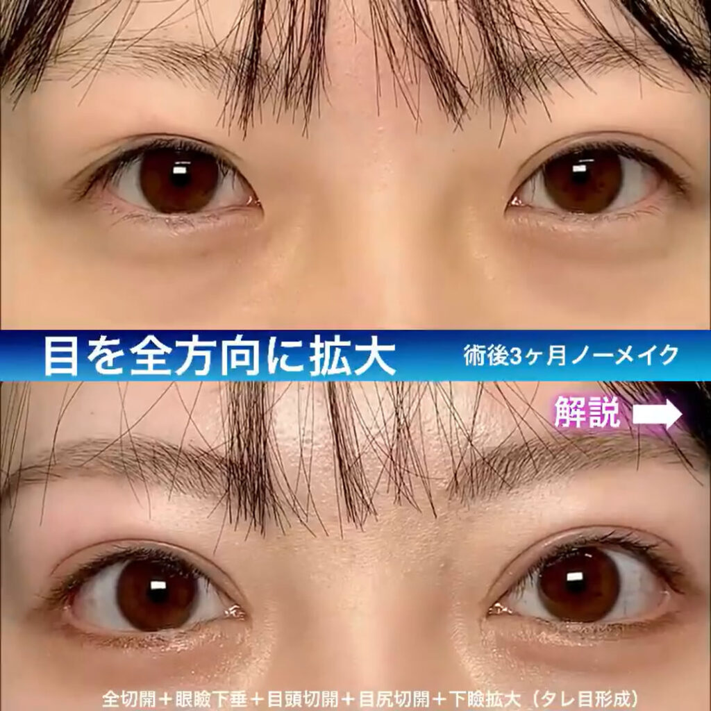 全切開+眼瞼下垂+目頭切開+目尻切開+タレ目形成を同時に行った症例