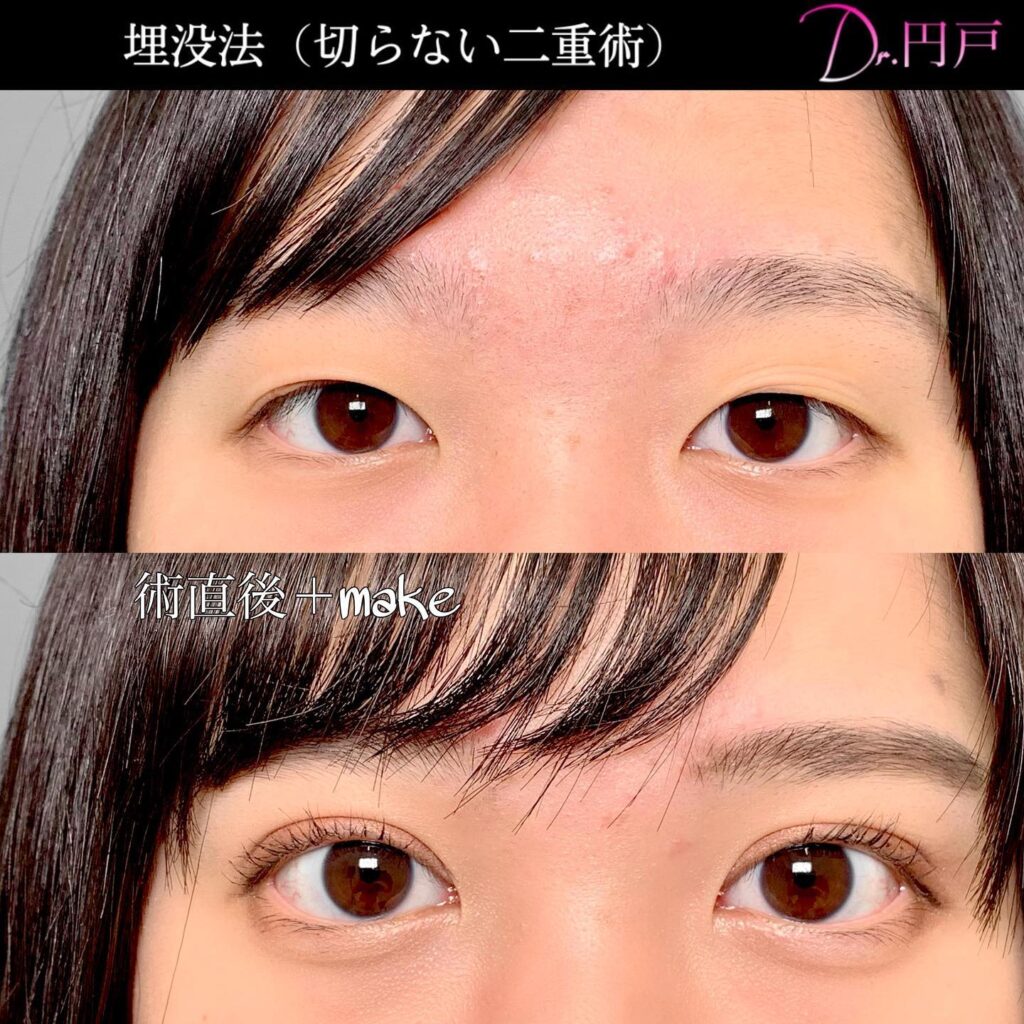  埋没法の術直後の症例