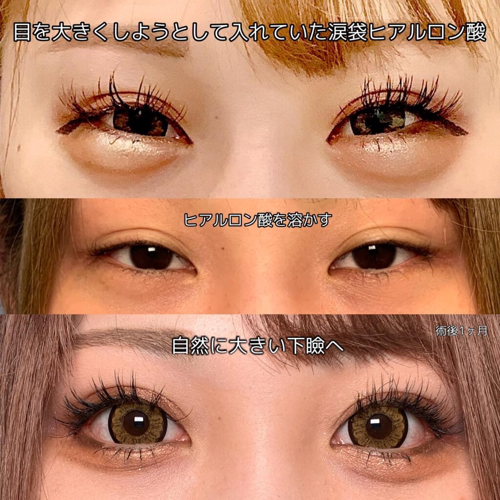 目尻切開とタレ目形成の症例写真