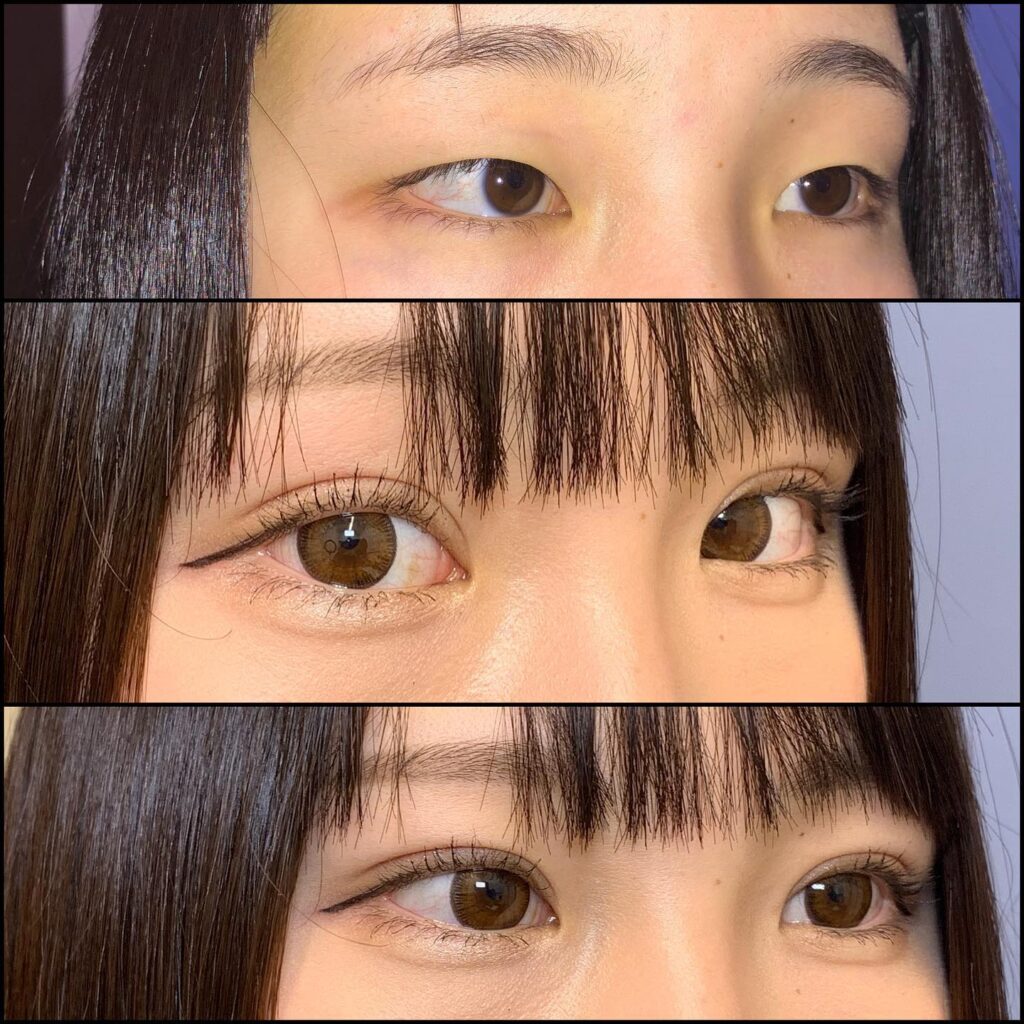 末広型と並行中間型のforever二重術の直後の症例