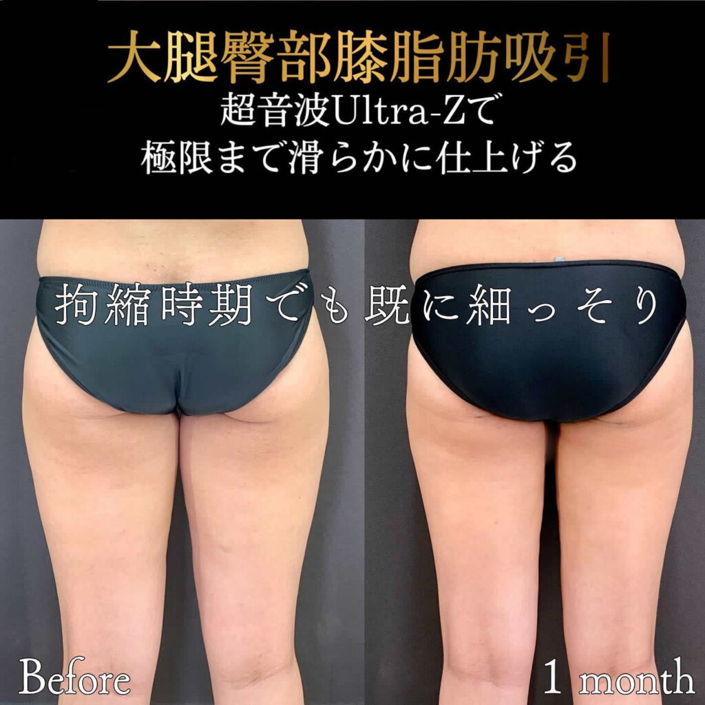 太腿の脂肪吸引の症例