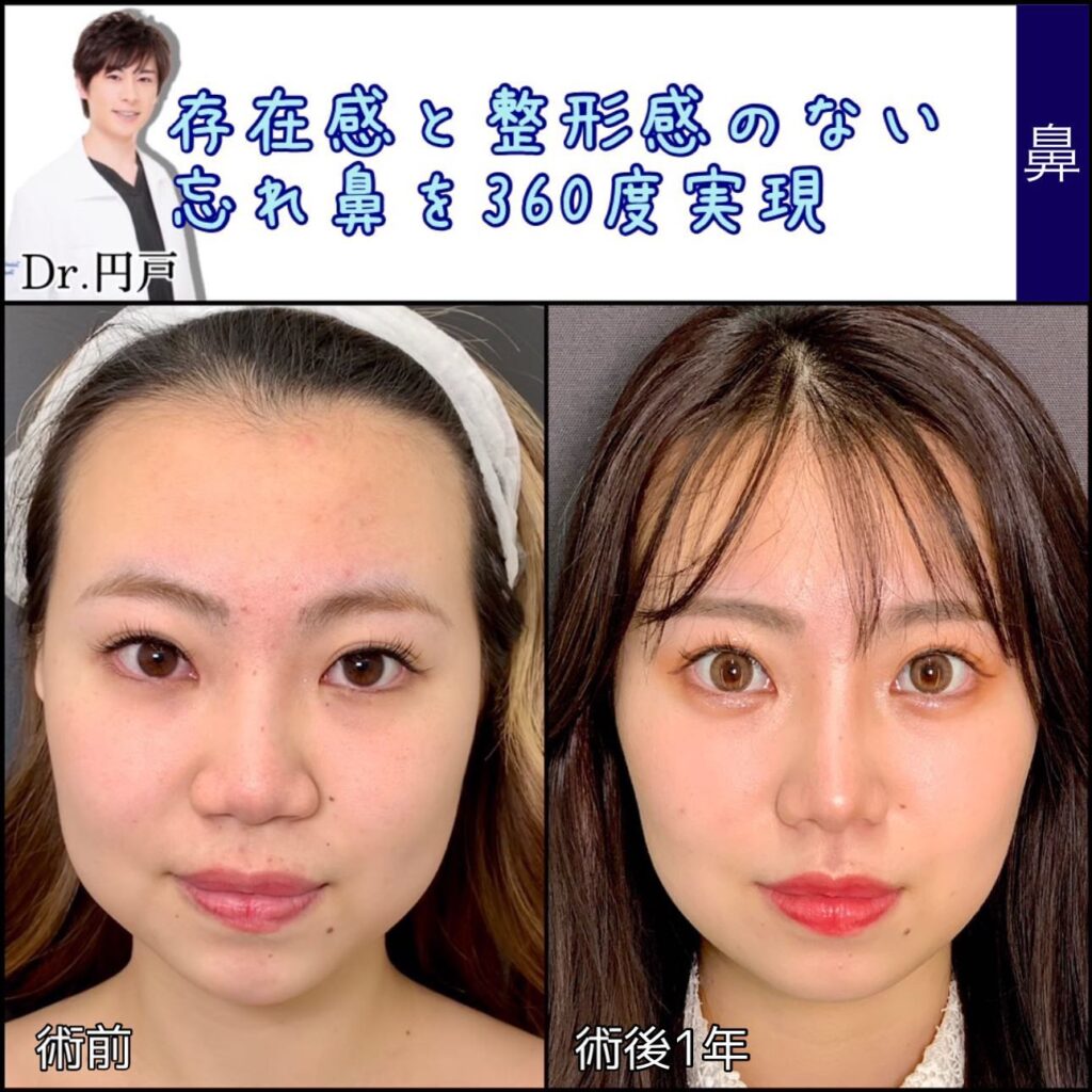 鼻尖形成と軟骨移植と鼻中隔延長と法令線基部人口真皮と鼻背部軟骨以上と小鼻縮小を同時に行った症例写真