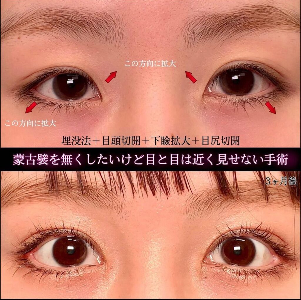 埋没法と目頭切開とタレ目形成と目尻切開を同時に行った全方位拡大術