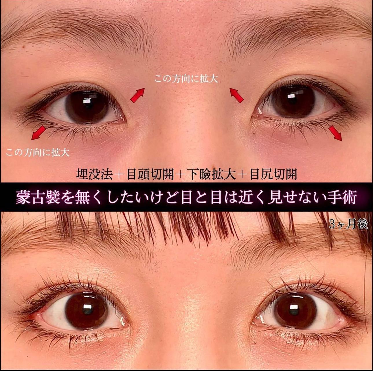 埋没法と目頭切開とタレ目形成と目尻切開を同時に行った全方位拡大術