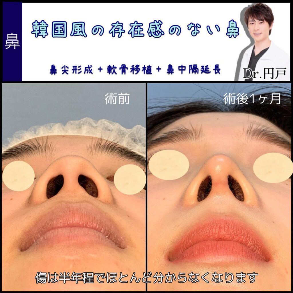 鼻中隔延長、軟骨移植、鼻尖形成の１ヶ月後の症