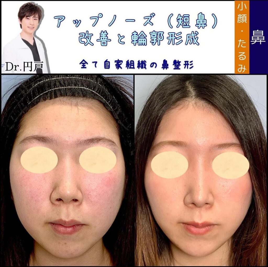 鼻中隔延長耳介と鼻背軟骨移植と鼻尖形成と軟骨移植を同時に行った症例写真