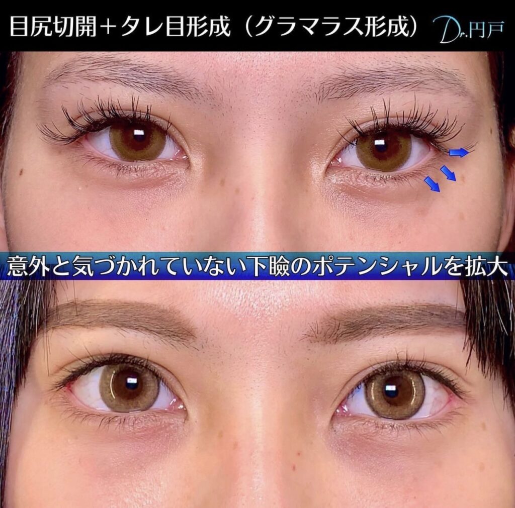 目尻切開とタレ目形成の症例