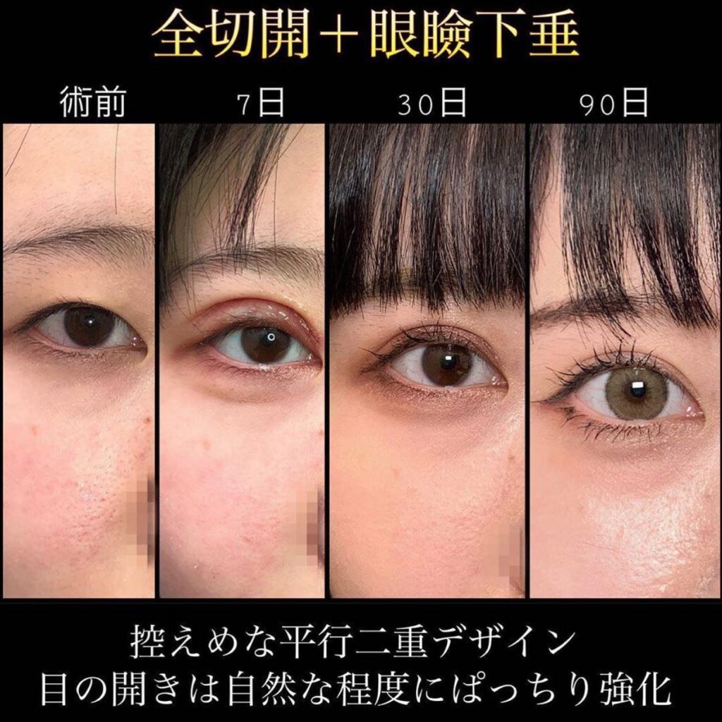 全切開と眼瞼下垂の経過の症例写真