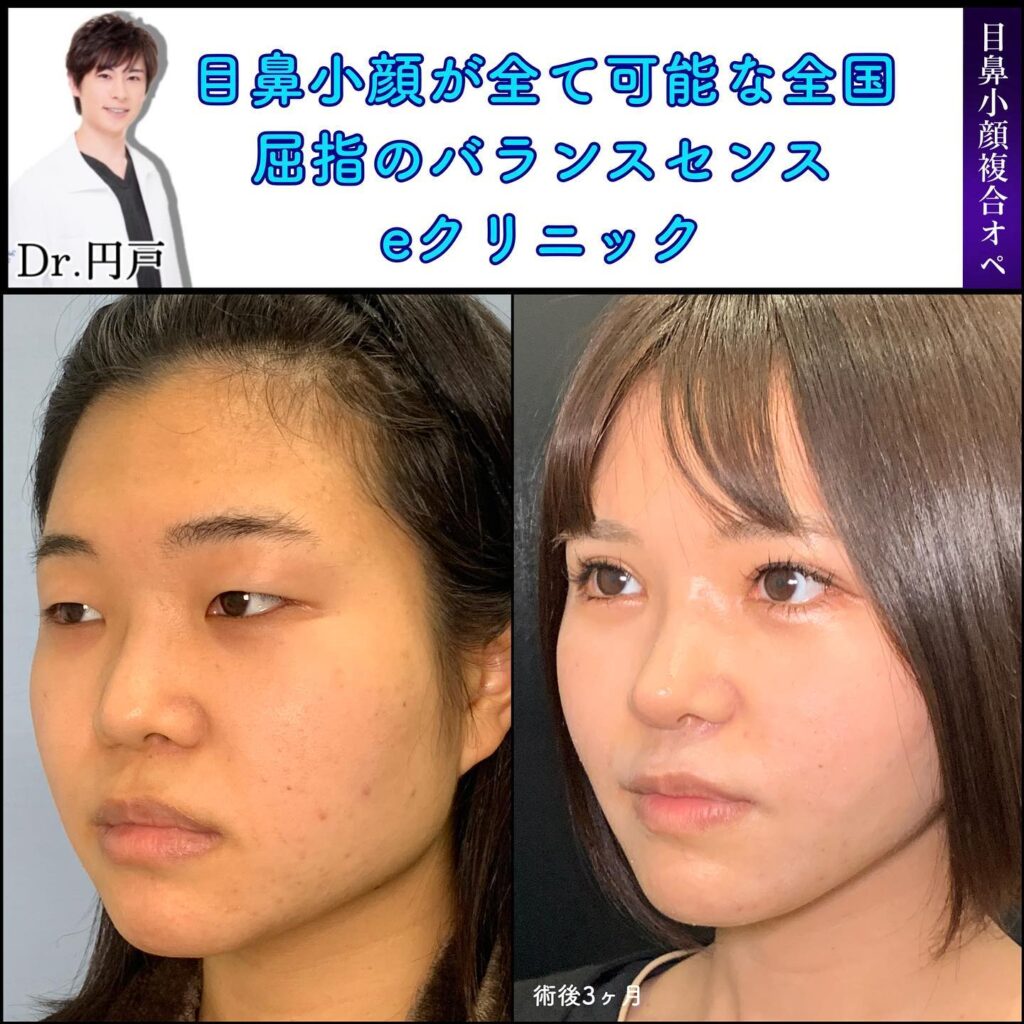 顔フル整形の症例写真