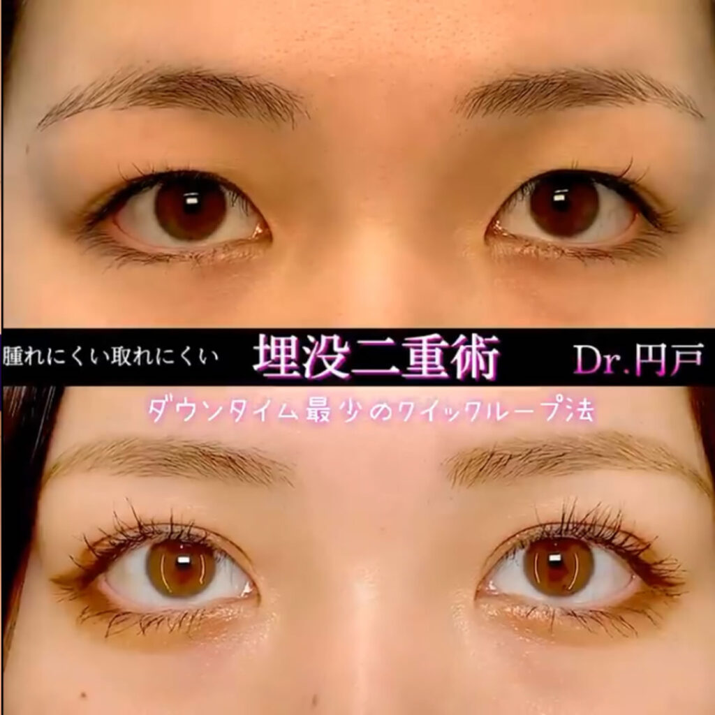 腫れにくい二重埋没法の症例写真