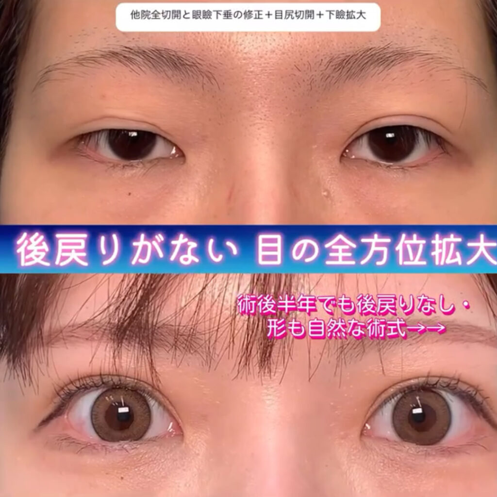 全切開と眼瞼下垂の他院修正と目尻切開と下瞼拡大の症例写真