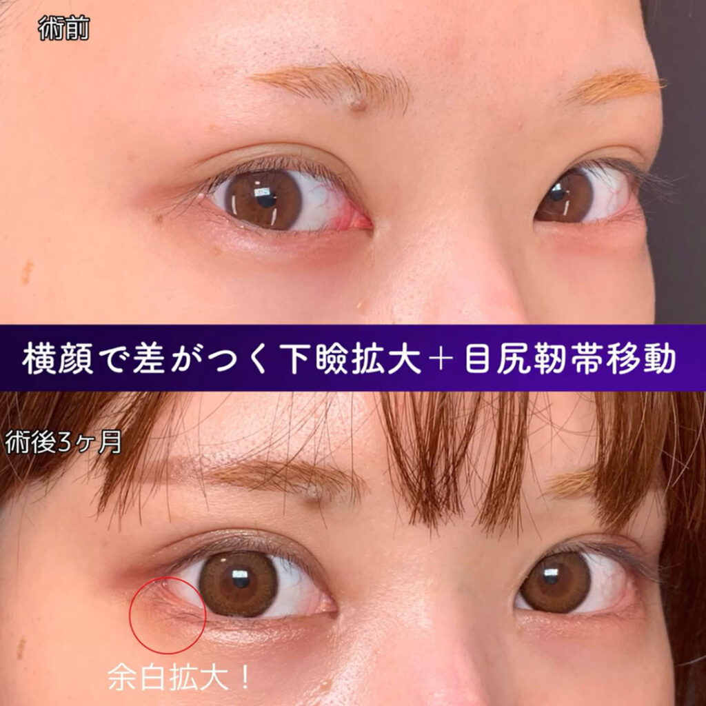目尻切開の斜めから見た３か月後の症例