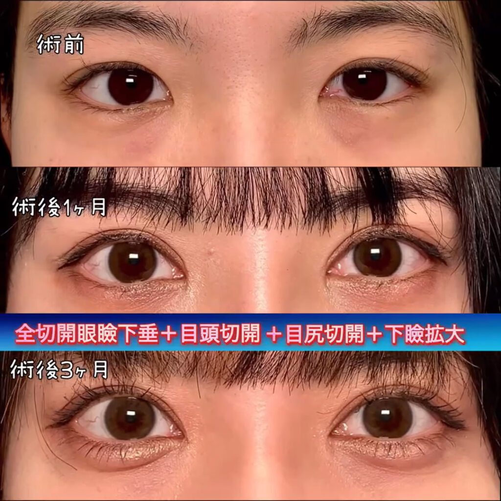 全切開と眼瞼下垂と目頭切開と目尻靱帯移動とタレ目形成とクマ取りの裏ハムラと涙袋形成術を同時に行った1ヶ月後と3か月後の症例