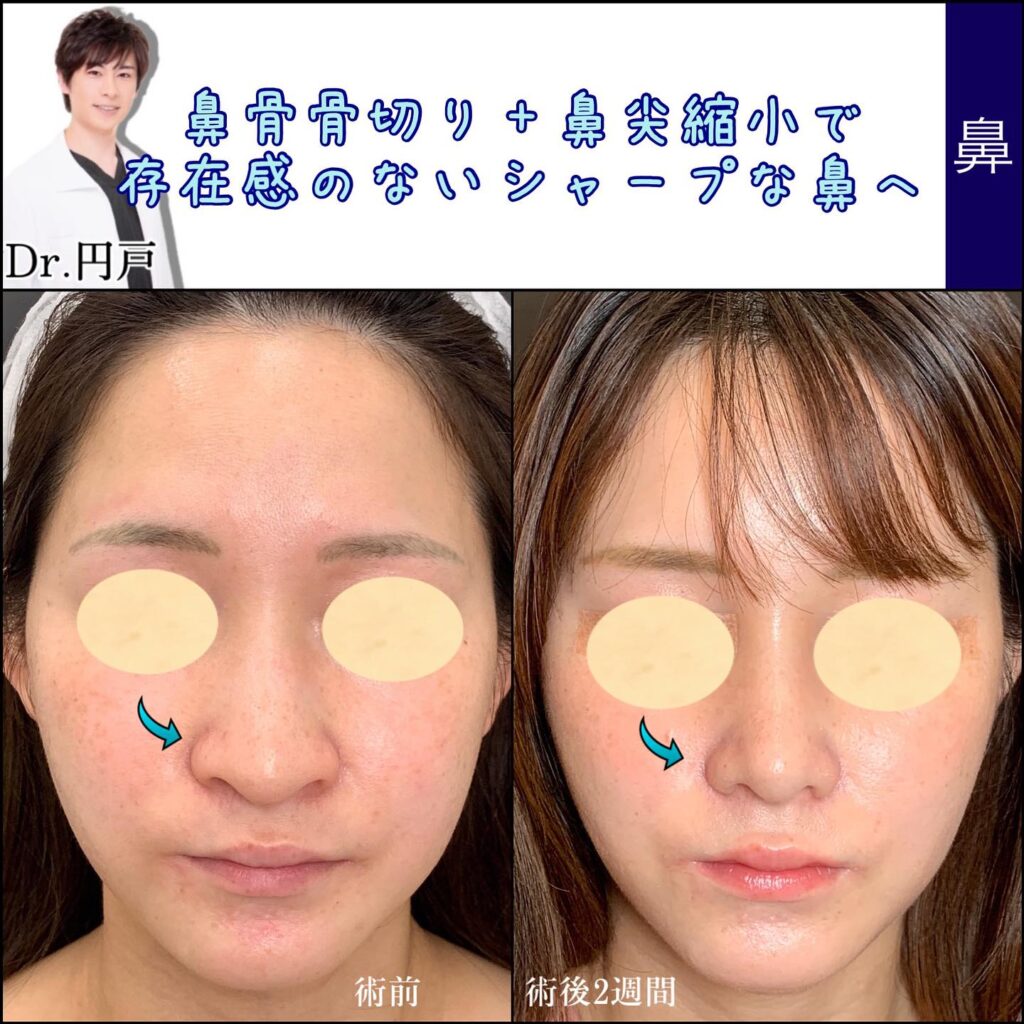 鼻骨骨切りの症例写真