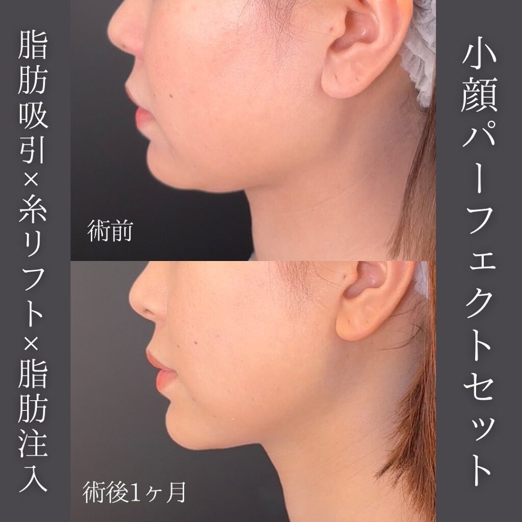 脂肪吸引と糸リフトの症例写真