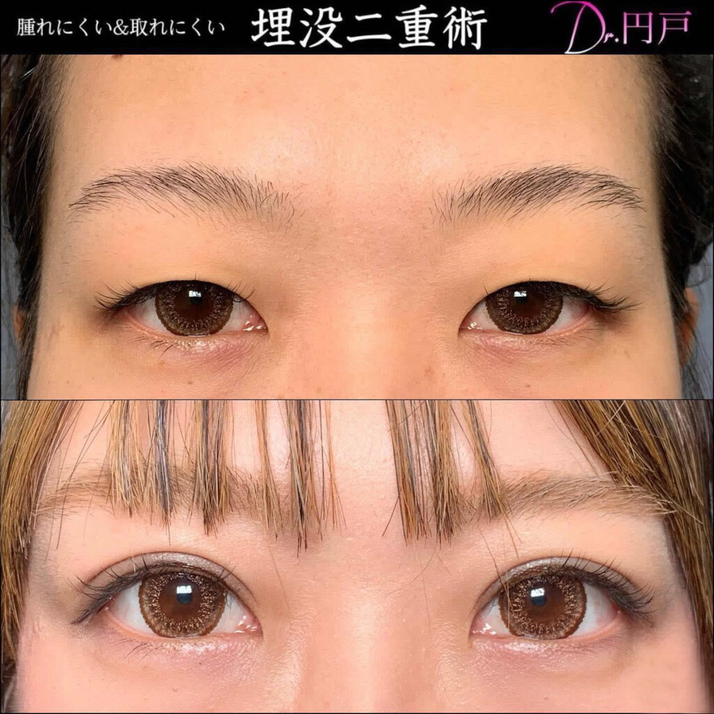 20代の正面から見た埋没法の症例