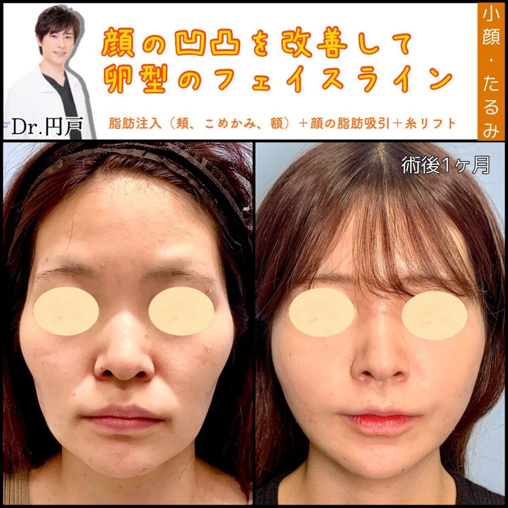 糸リフトと顔の脂肪吸引の症例写真