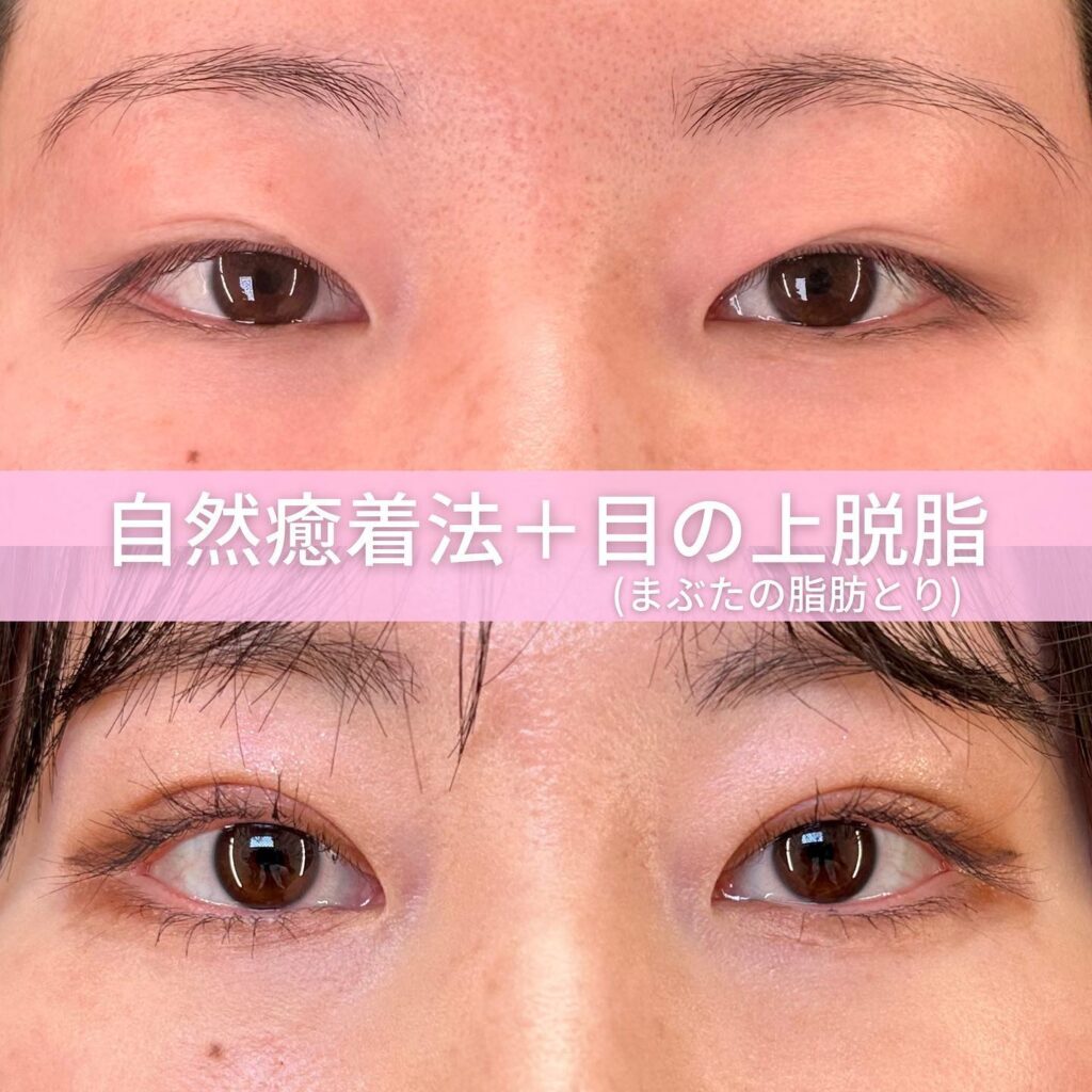 自然癒着法と目の上の脱脂の症例写真