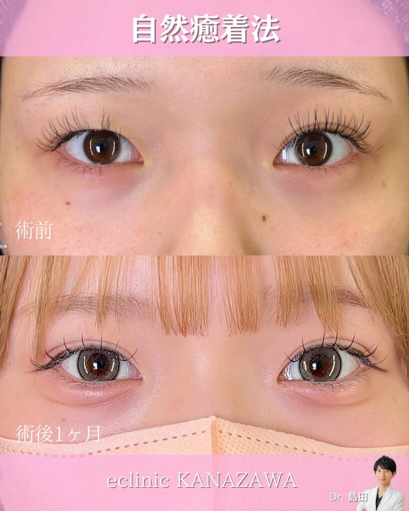 自然癒着法の症例写真 (2)