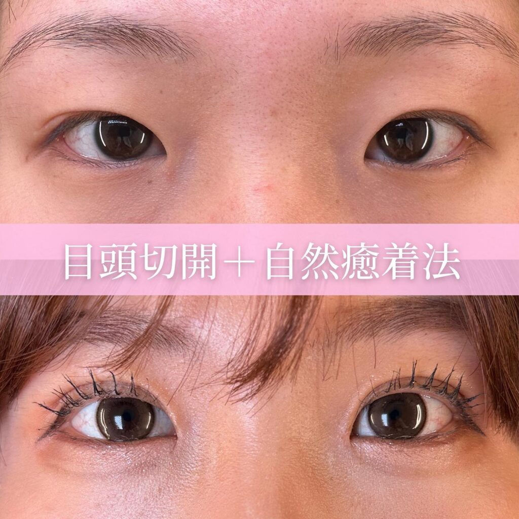 目頭切開と自然癒着法の症例写真 (2)