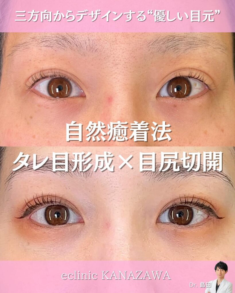 自然癒着法とタレ目形成と目尻切開の症例写真