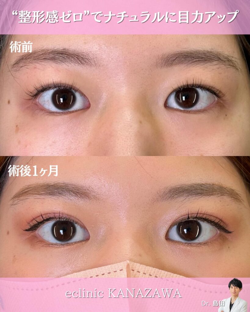 自然癒着法の症例写真 (3)