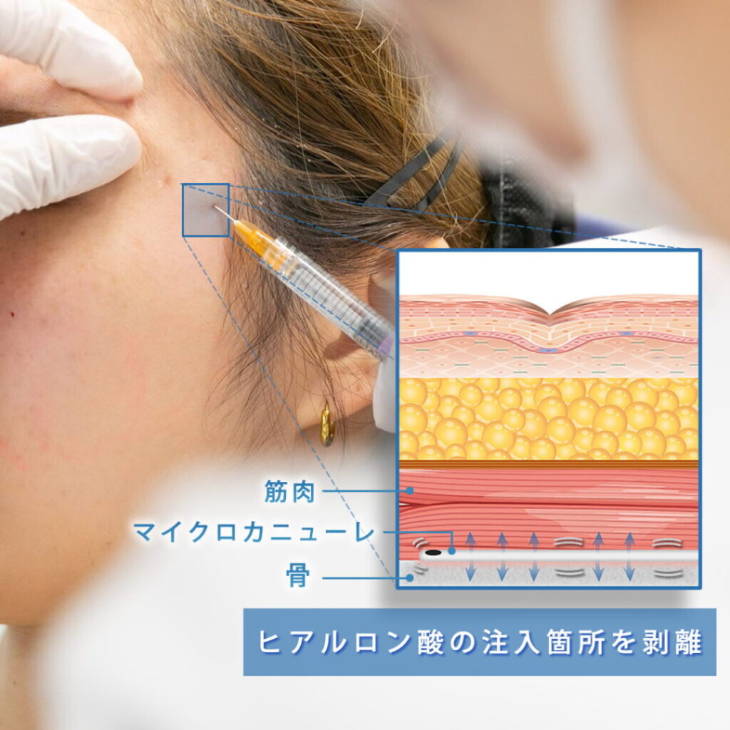 こめかみの骨膜をマイクロカニューレで剥離しているところ