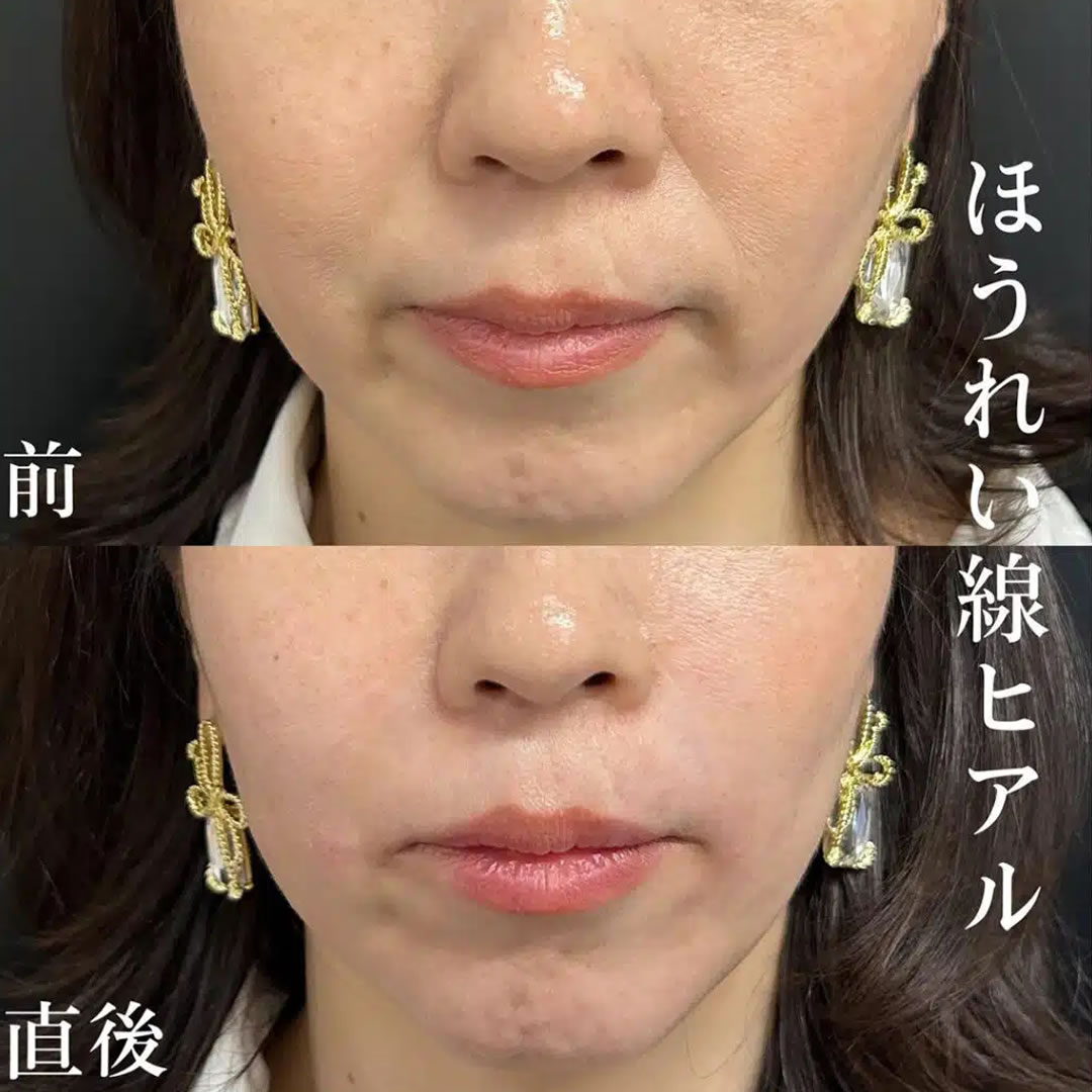 ほうれい線にヒアルロン酸注入した女性の症例写真