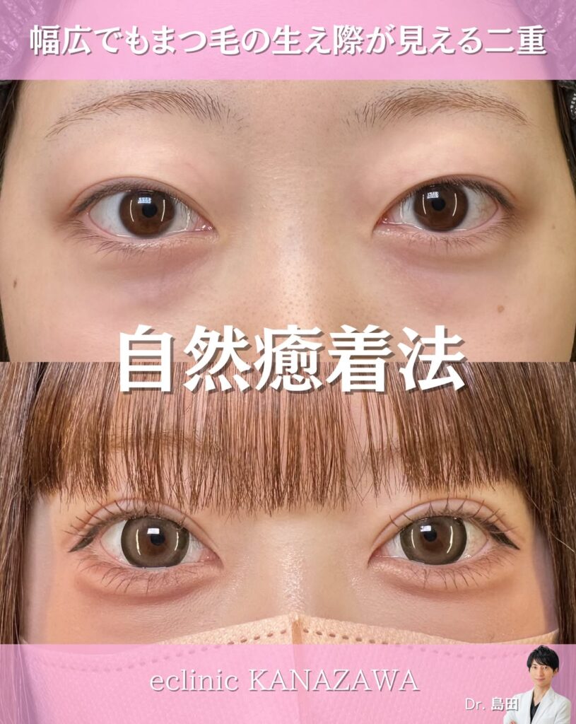 自然癒着法の症例写真 (4)
