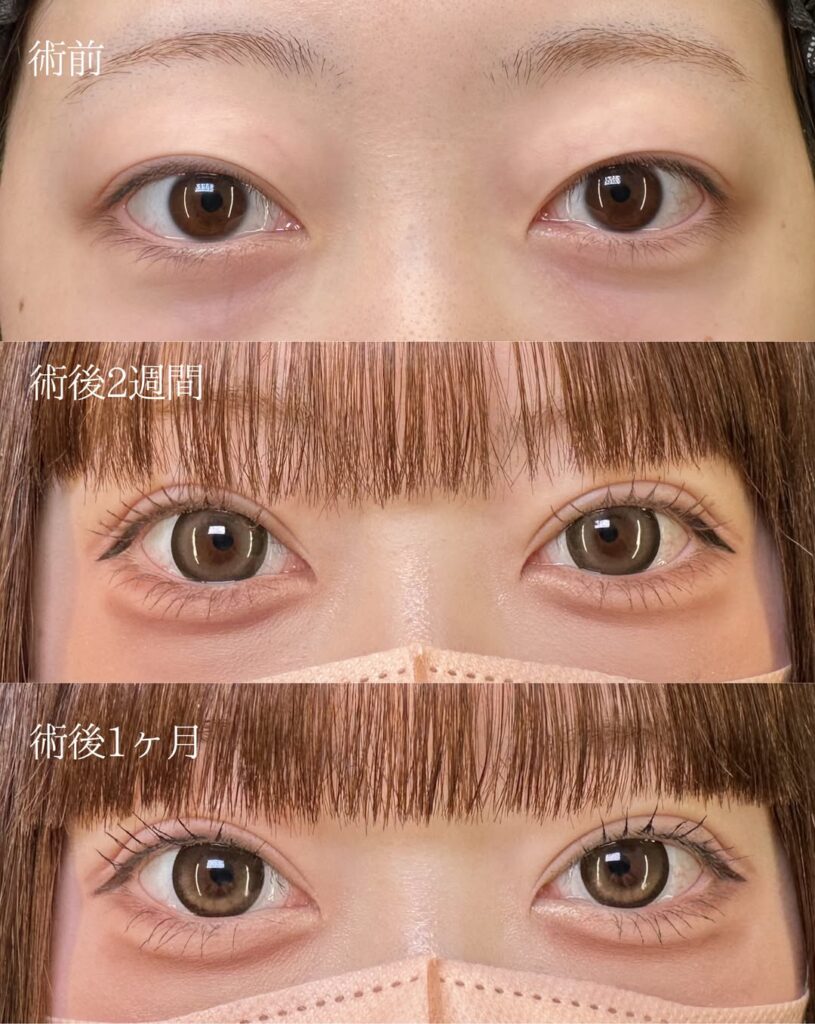 自然癒着法の症例写真 (3)