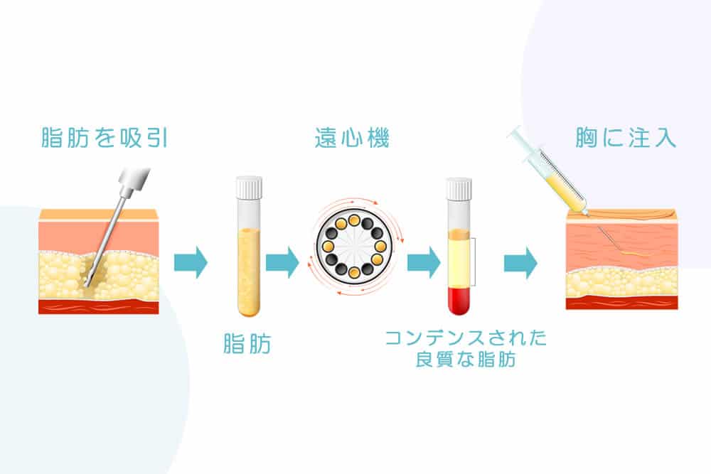 コンデンス豊胸の仕組み